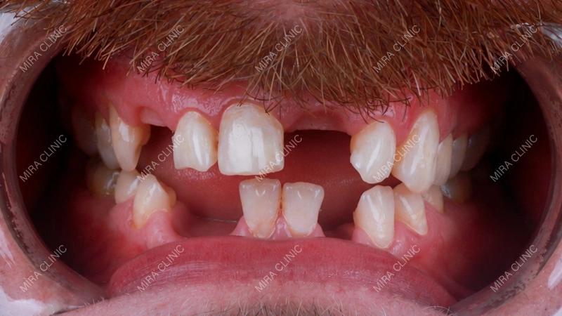 I Have 6 Missing Teeth — Do I Need 6 Implants?